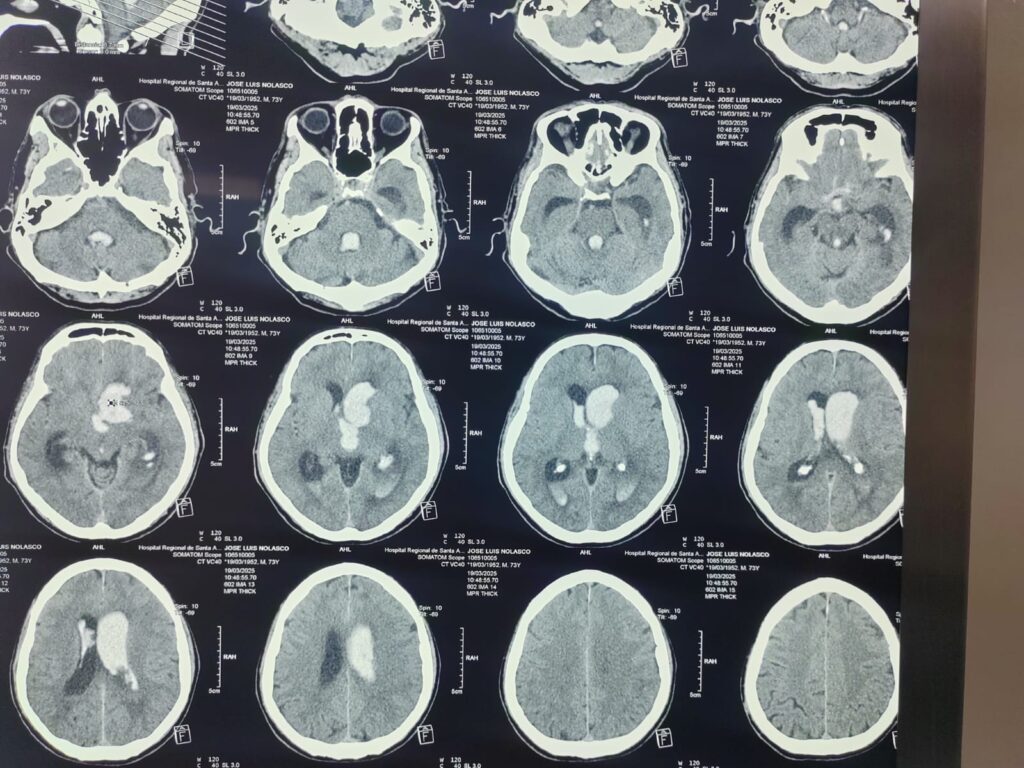 sangrado intracerebral