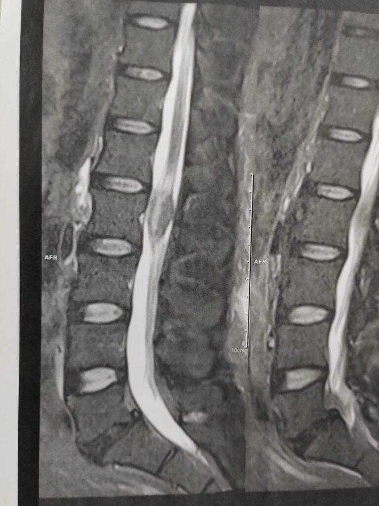 Tumor en Columna